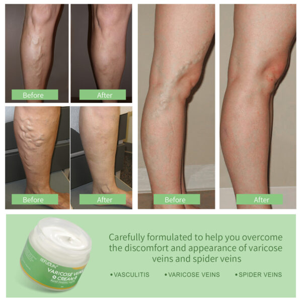 Vein Repair Cream – Relieves Red Streaks, Bruises & Varicose Veins, Skincare Lotion - Image 4