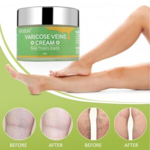 Vein Repair Cream – Relieves Red Streaks, Bruises & Varicose Veins, Skincare Lotion